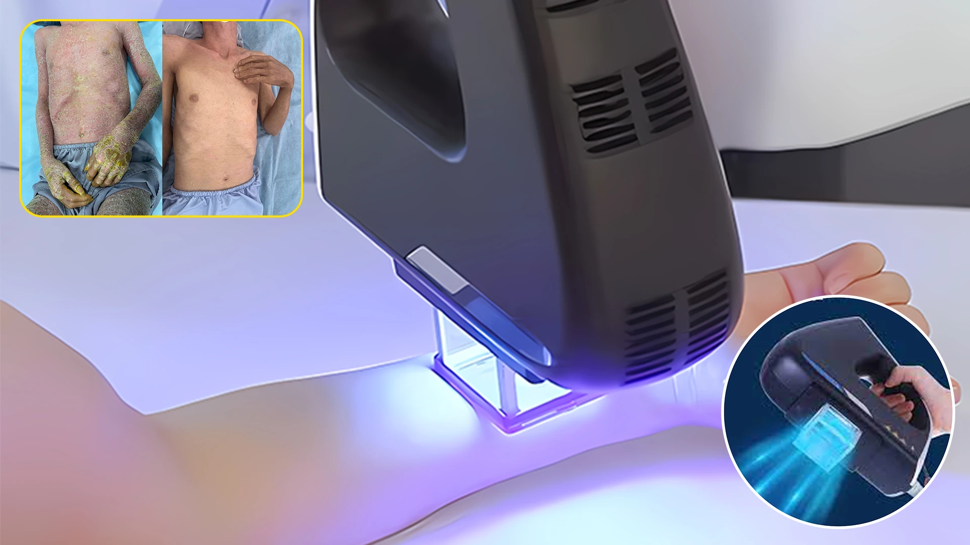 Excimer Premium adalah Solusi Modern Membantu Pasien Psoriasis Kembali Percaya Diri